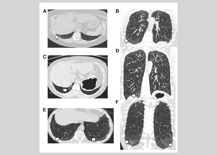 We reported mechanisms of alveolar epithelial cell dysfunction in presymptomatic pulmonary fibrosis (Kropski et al. AJRCCM 2015. 191:417-26)
