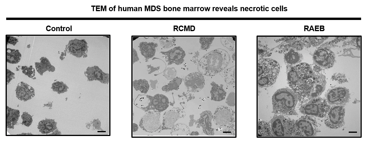 TEM of human MDS bone marrow reveals necrotic cells