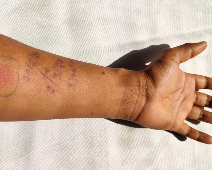 An outstretched arm with research test markings on the skin.