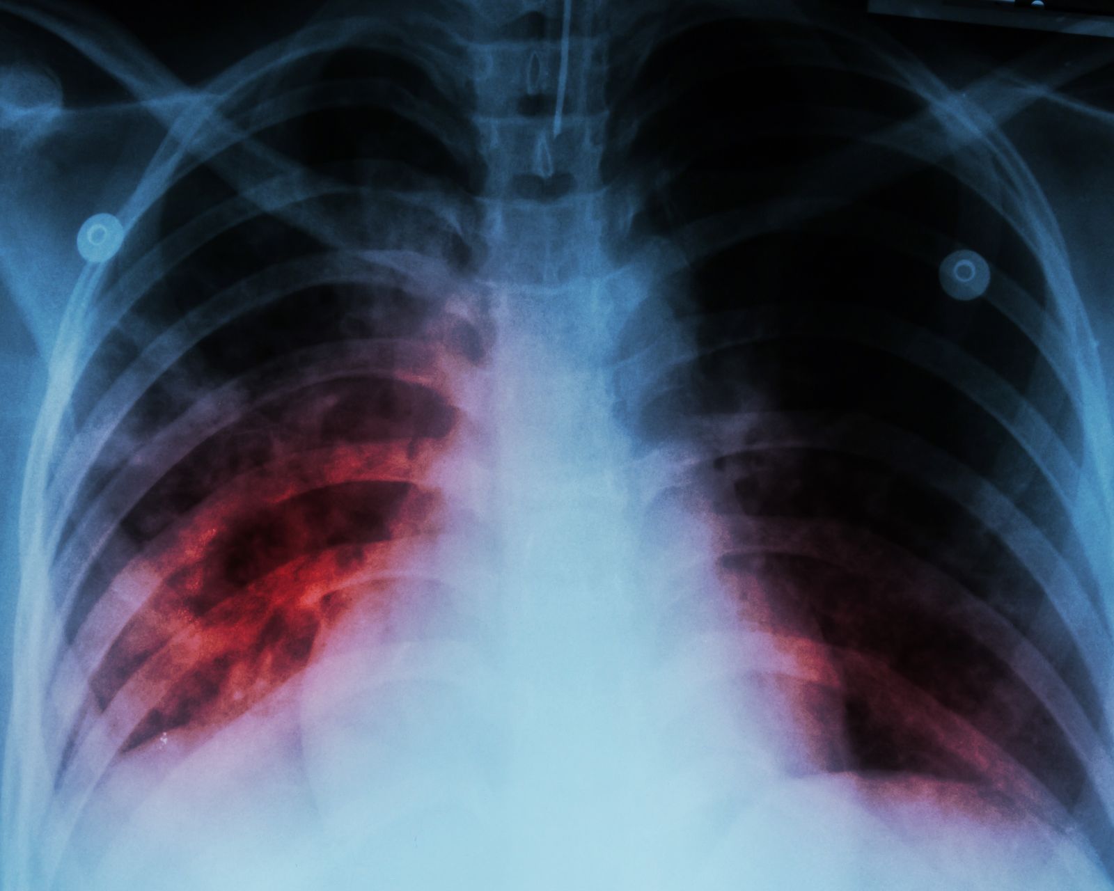 A chest x-ray shows alveolar infiltration at both lung due to mycobacterium tuberculosis infection