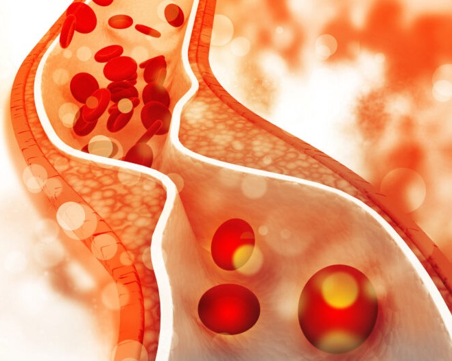 A yellow and red toned image of atherosclerosis.