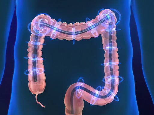 A colonoscopy image of the human intestine. 