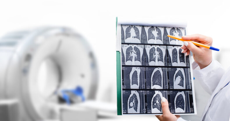 Low-dose chest CT scans can detect lung cancer early.