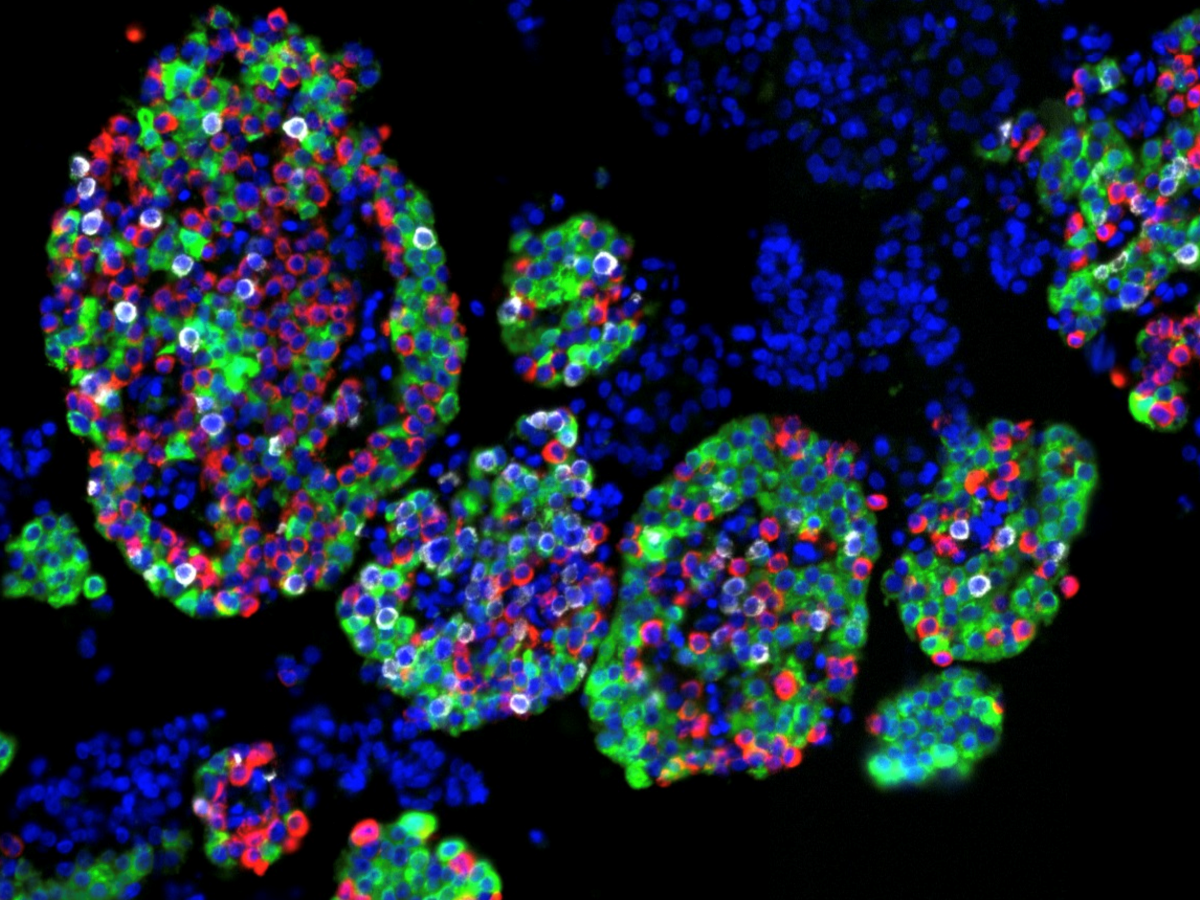 Immunofluorescence image of the pancreatic islets of a 50-year-old female without diabetes. This individual had 54% beta cells (green), 9% delta cells (white) and 37% alpha cells (red).