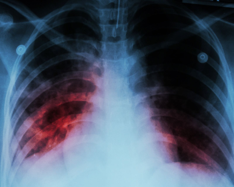 A chest x-ray shows alveolar infiltration at both lung due to mycobacterium tuberculosis infection